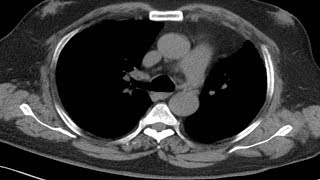 Cross sectional and imaging anatomy of the thorax [upl. by Notsag]