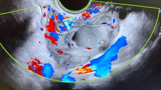 Ultrasound of acute salpingitis thick vascular fallop tube endometriotic simple amp nabothian cyst [upl. by Lunn104]