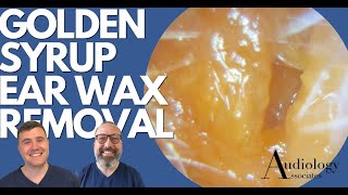 GOLDEN SYRUP EAR WAX REMOVAL  EP888 [upl. by Newol]