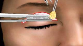 BLEFAROPLASTIA SUPERIOR DR FERNANDO PEDROZA [upl. by Ettenahs289]