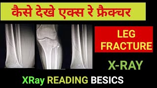 x ray fracture kaise dekhe leg with knee fractureTechcpd [upl. by Neom]