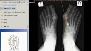 TraumaCad  Hallux Valgus Angle [upl. by Aprilette498]