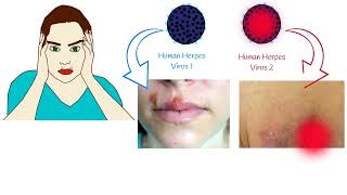 Oral Herpes and Genital Herpes Symptoms and Treatment Herpes Simplex Virus [upl. by Demp]