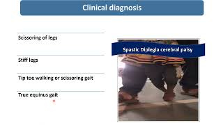 Spastic Diplegic Cerebral Palsy  Spot Diagnosis  7  Pediatrics [upl. by Holtorf]