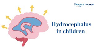 Hydrocephalus in children  Medical Tourism [upl. by Euqinim]