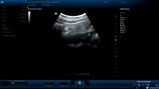 Appendicitis  ultrasound cases [upl. by Lennor]