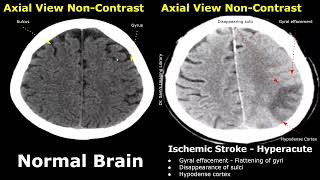 CT Scan Brain Normal Vs Ischemic Stroke Images  NonContrast HyperacuteAcuteChronic Infarction [upl. by Rube]