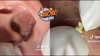 Ultimate ASMR Acne Extraction Compilation  Satisfying Pimple Popping amp Blackhead Removal [upl. by Deanne]