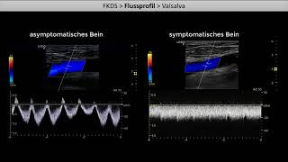 Kompressionssonographie der Beinvenen  Teil 2 Exkurs FKDS und Flussprofil [upl. by Josy]