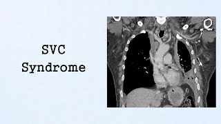 SVC Syndrome Oncologic Emergencies [upl. by Hourigan]