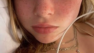 ღ your upper lip touches your nose  philtrum reduction surgery 💉 [upl. by Kurtz]