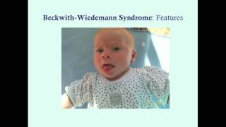 BeckwithWiedemann Syndrome  CRASH Medical Review Series [upl. by Fadas]