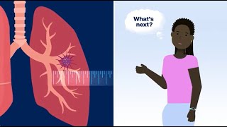 What Happens After Your Doctor Finds a Lung Nodule Pulmonary Nodule [upl. by Deys909]