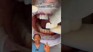 Replacing missing teeth with dental bridge dentalbridge missingteeth toothreplacement teethbits [upl. by Ponce]