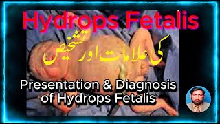 Presentation and Diagnosis of Hydrops Fetalis کی علامات اور تشخیص Hydrops Fetalis [upl. by Bridgid]