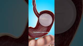 How a Gastric Balloon Helps with Weight Loss 😮  shorts viralvideo  Creativelearning3d [upl. by Leonie]