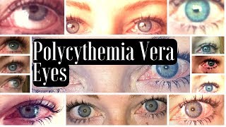 MPN Polycythemia Vera Blood Shot Red Eye Manifestations [upl. by Aibun140]