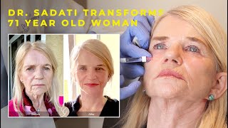 Dr Sadati Transforms 71 year old Woman with Lower Face and Neck Lift and Restylane Lyft Filler [upl. by Esihcoc]