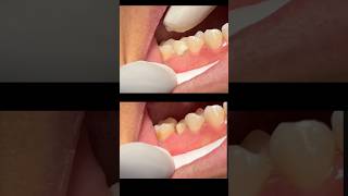 Crown  Tooth Restoration [upl. by Namyac]