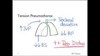 Pneumothorax Part 1 [upl. by Naltiac]