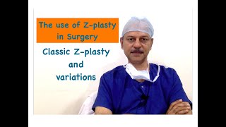 zplasty All you wanted to know about Z plasty [upl. by Wrench]