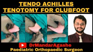 How to do a Tenotomy in Clubfoot [upl. by Aynor795]