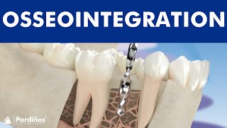 How does an implant work Osseointegration of dental implants © [upl. by Eisaj549]