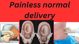 Painless normal delivery pregnancy labour painlessdeliverypregnancy [upl. by Etteval949]