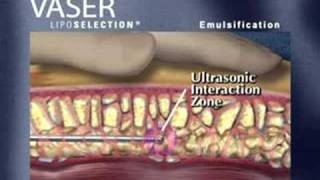 VASER Technique Overview [upl. by Adnolat]