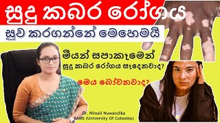 Vitiligo  Leukoderma  සුදු කබර සුව කරගන්නේ කොහොමදමෙය බෝවෙනවාද  Dr Nimali Nuwandika [upl. by Einhpets]