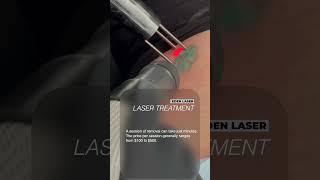 Laser Tattoo Removal Process [upl. by Daitzman738]