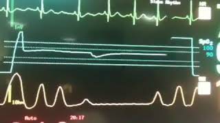 Cheyne Stokes Respiration recorded on cardiac monitor [upl. by Carlos775]