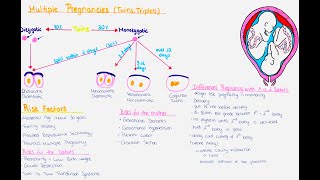 Multiple Pregnancy Twins Triplets  Zygosity Chorionisity Amnionisity Risks Delivery [upl. by Stalder]