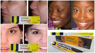 TRETINION ACNESOL CREAM YAA ISTICMALI KARO MUXUSA TARAA IYO… [upl. by Hobart724]