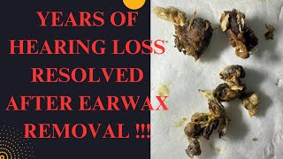 YEARS Of Hearing Loss RESOLVED After This SATISFYING Earwax Removal MUST WATCH Video [upl. by Fagaly]