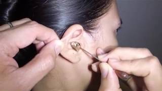 Womans Earwax Finally Removed after 25 Years [upl. by Ellicul]