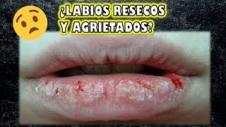 ¿LABIOS RESECOS Y AGRIETADOS  Tengo la solución [upl. by Duong675]