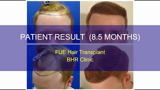 FUE Hair Transplant Result  2500 Grafts 0 days to 85 Months Post Operation [upl. by Erena]