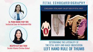 DETERMINING THE LATERALITY OF THE FETAL BODY  LEFT HAND RULE OF THUMB  FETAL ECHOCARDIOGRAPHY [upl. by Cormac]