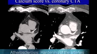 UCSF Radiology Calcium Scoring vs Coronary CTA Scan [upl. by Jaban825]