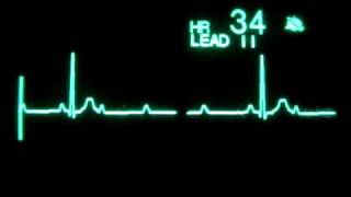 2nd Degree Atrioventricular Block Type II with 31 Block [upl. by Attenwad416]