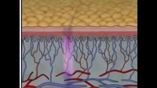 Phases of Wound Healing Pt 2  Wound Care Management  WoundEducatorscom [upl. by Ardnac]