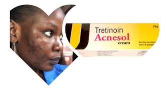 Skin care update 💚 Trying out Tretinoin Acnesol  3 months update on NIVEA [upl. by Joashus]