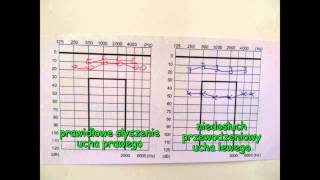 Jak odczytać wynik badania słuchu Co oznacza audiogram [upl. by Micheil]