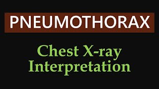 Pneumothorax amp Tension Pneumothorax  Chest Xray Interpretation [upl. by Aiket]