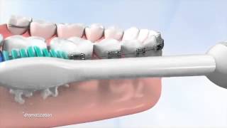 Tips on how use a Philips Sonicare toothbrush with braces Hygiene is a key part of daily care [upl. by Ettessil]