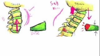 Headaches 101 Tension Headaches [upl. by Jea]