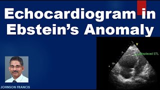 Echocardiogram in Ebsteins Anomaly of Tricuspid Valve [upl. by Paley]