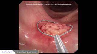 Endoscopic Mycosal Resection EMR procedure overview of a sessile polyp using Olympus devices [upl. by Ylrebma85]