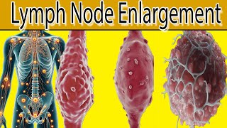 Lymph Node Enlargement  7 Most common causes [upl. by Neerihs975]